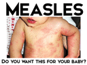 Measles